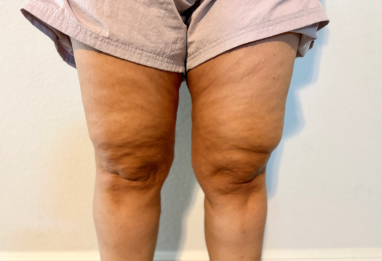 Leg's woman with lipedema